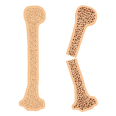 Osteoporose gebroken bot